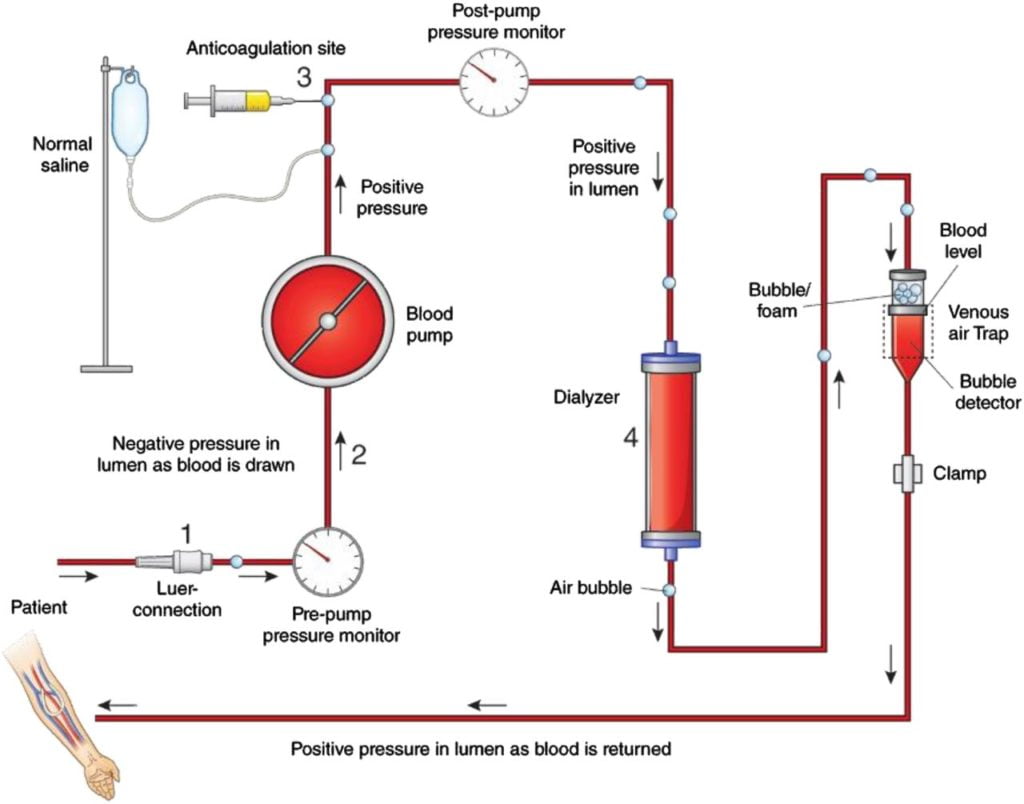 Diagram: Dialysis
