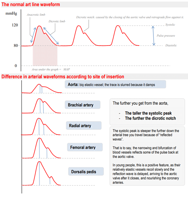 Diagram used in Procedure – Arterial Access — Master Answer