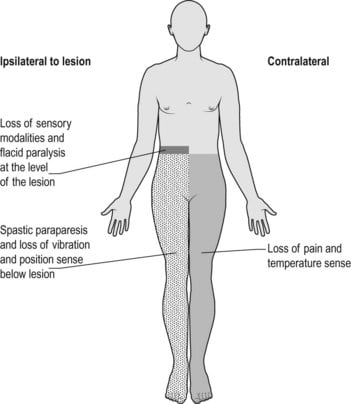 Diagram: Brown-sequard syndrome: Hemisection of the cord