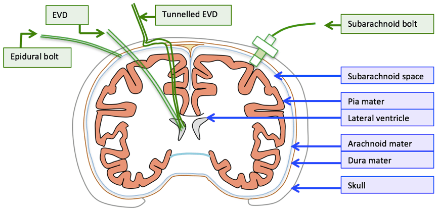 Diagram used in Neuro Measurement – ICP — Master Answer